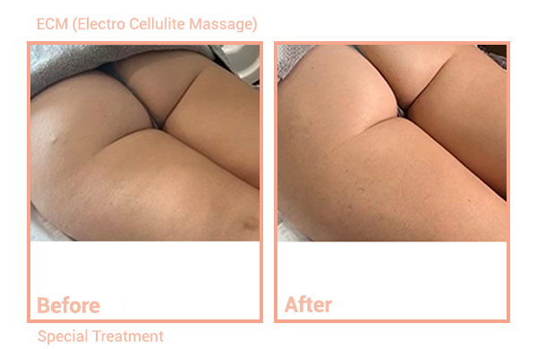 The Synergy Medi spa System Gives an instant lift, shapes and tones the buttock and thigh area