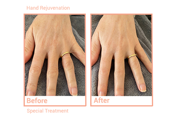 Hand Rejuvenation & Signature Non-Surgical Facial Toning Medi Spa Treatments before and after pics