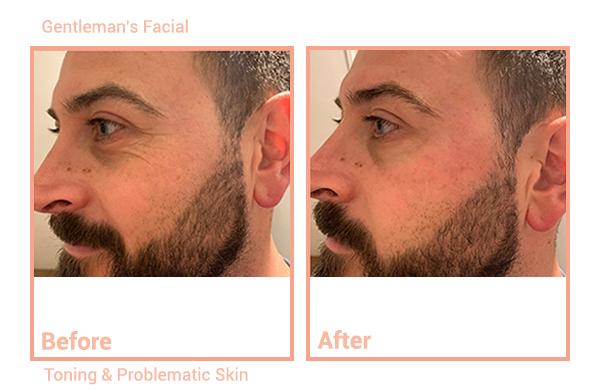 Gentlemans' Facial Toning and Problematic Skin