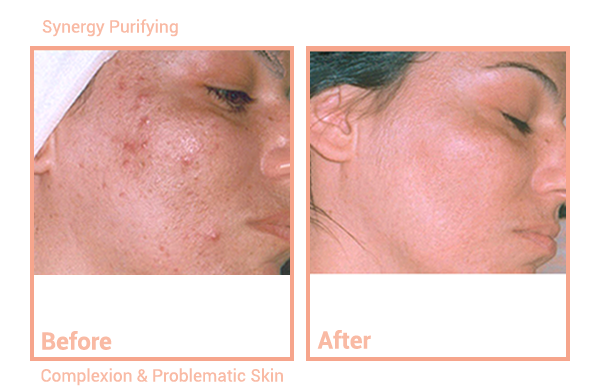 Synergy System Purifying, problematic skin Day Spa Treatments