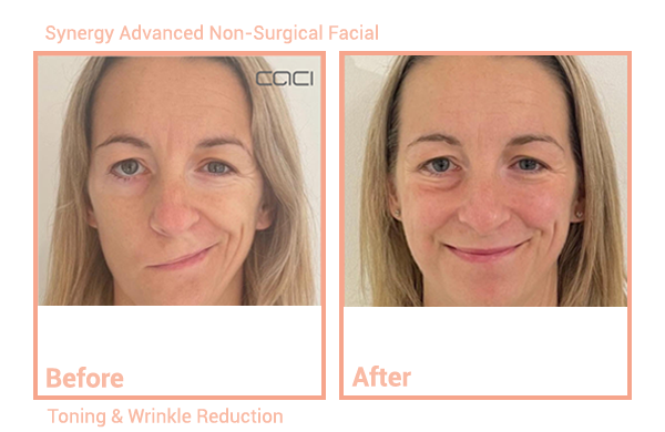 Non-Surgical Facial, Toning & Wrinkle Reduction