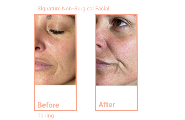 Synergy System Signature Non-Surgical Facial Toner Treatment