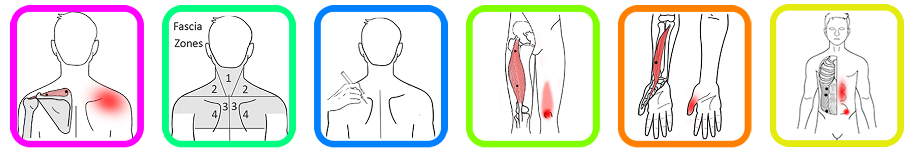 Targeting Myofascial Trigger Points: Advanced Techniques for TENS and Microcurrent Devices